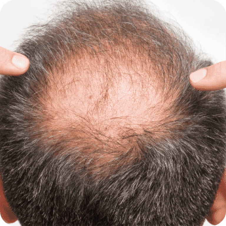 Male Hair Loss